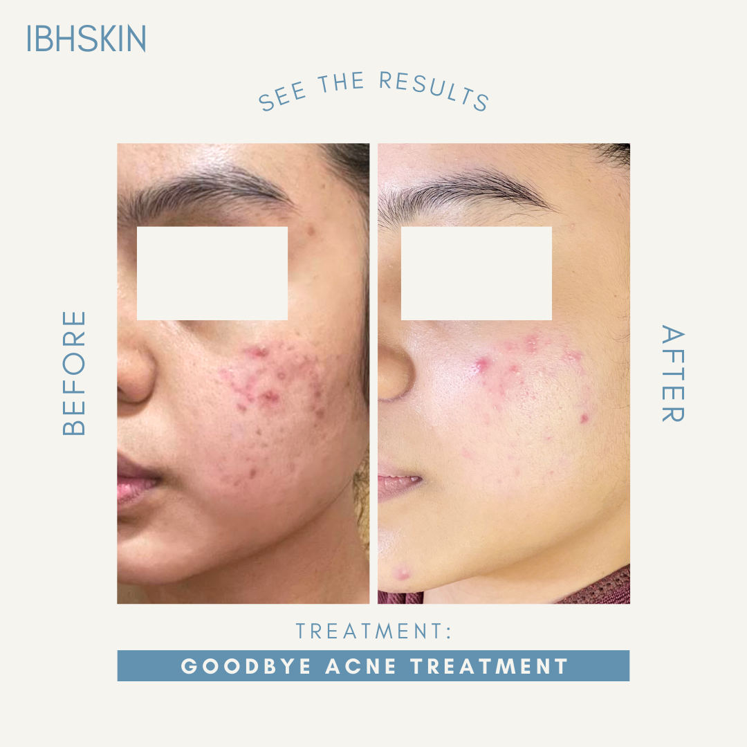 Goodbye Acne Treatment