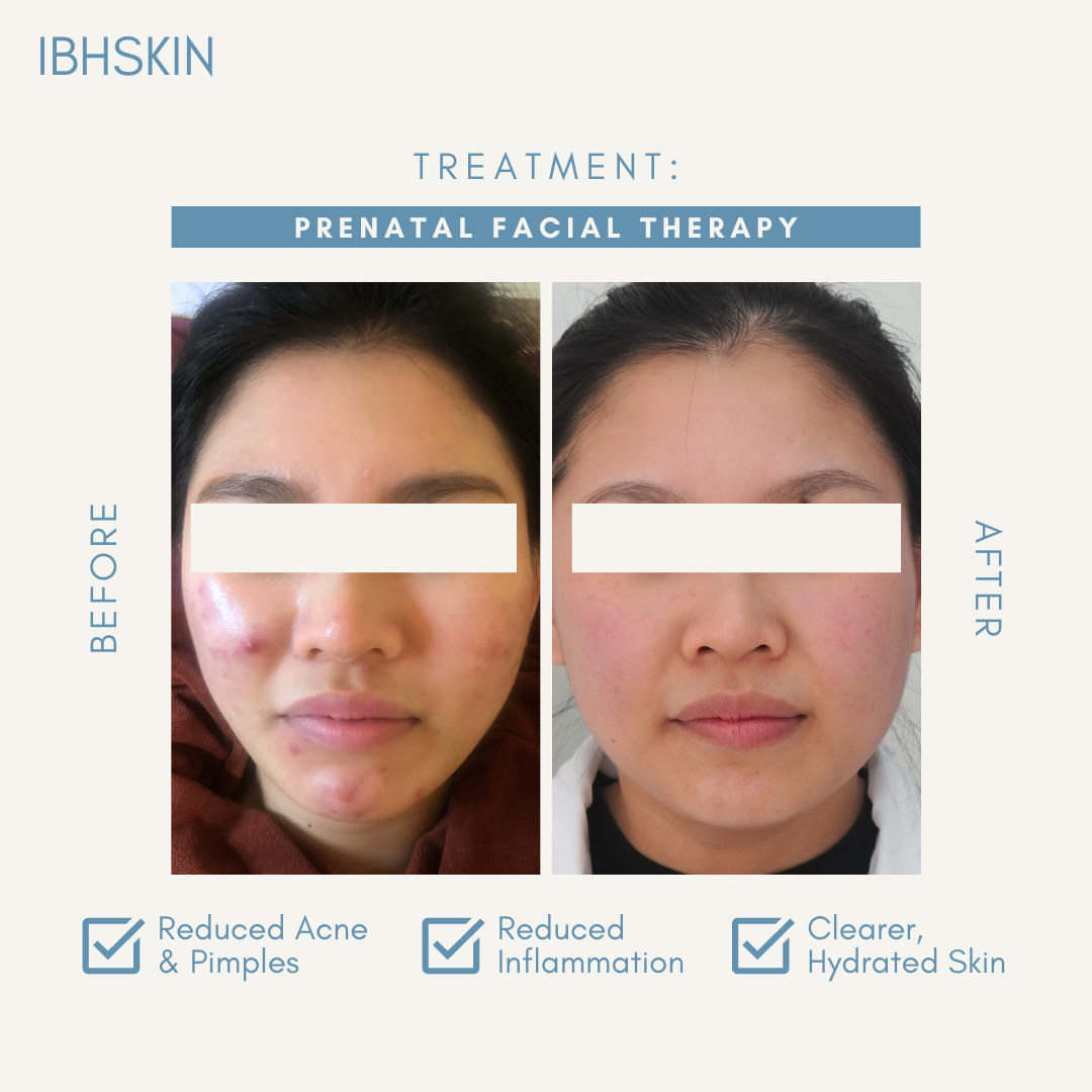 Prenatal Facial Therapy