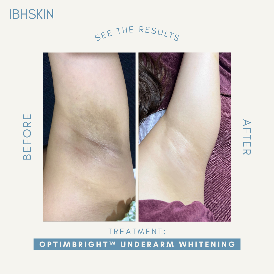 OptimBright™ Underarms Whitening