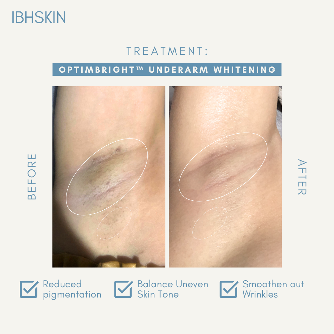 OptimBright™ Underarms Whitening