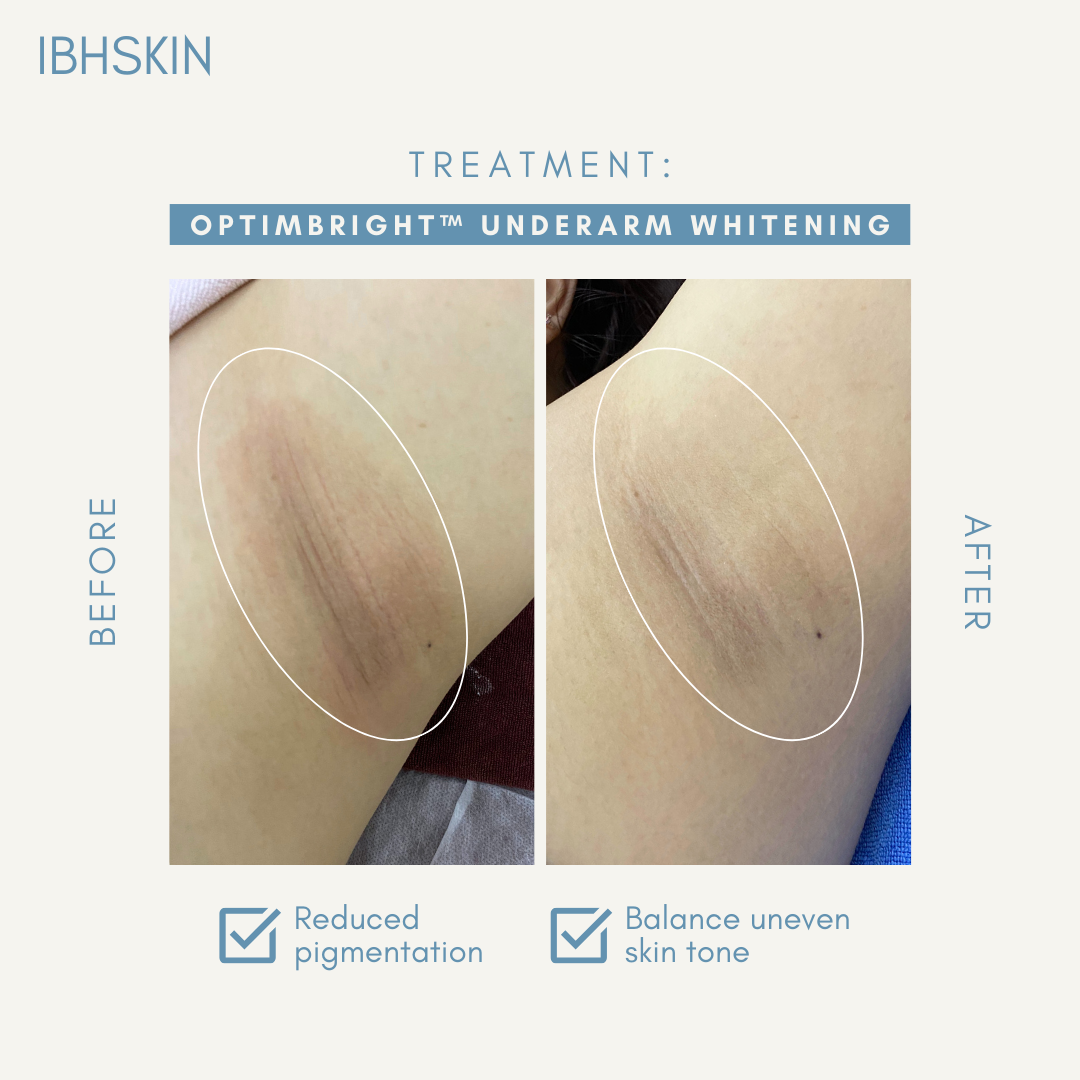 OptimBright™ Underarms Whitening