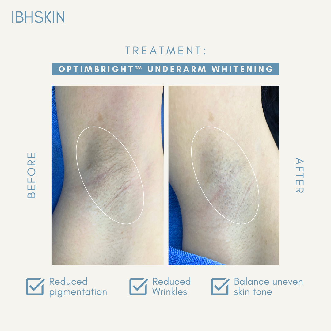 OptimBright™ Underarms Whitening