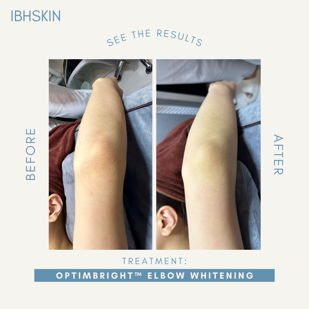 OptimBright™ Elbow Whitening