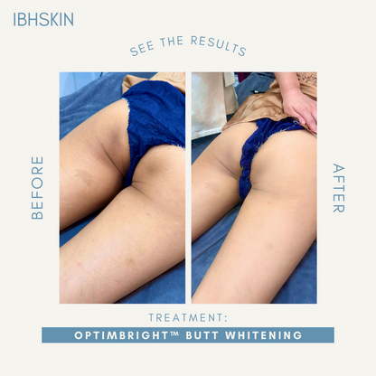 OptimBright™ Butt Cheek Whitening