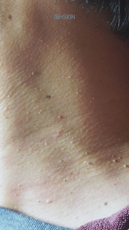 Milia Seed/ Mole/ Skintag Removal